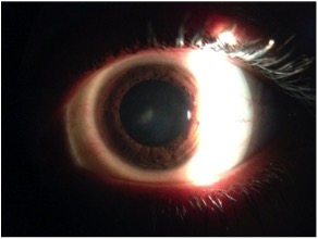 scleral contact lenses @ mark hinds optometrists