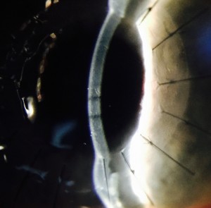 new corneal graft stitches corneal specialist Dr Brendan Cronin @ Queensland Eye Institute QEI @ Mark Hinds Optometrists, specialty contact lenses, keratoconus, scleral contact lenses, orthoK Brisbane, children’s optometrist, contact lens specialist, synergeyes contact lenses, keratoconus contact lenses, orthokeratology, hard contact lenses, maui jim, RGP contact lenses, corneal specialist, optometrist Brisbane, myopia control – phone 07 3358 6566 / orders@markhindsoptometrists.com.au ; voted Brisbane’s best optometrist 