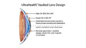 ultrahealth contact lenses, synergeyes, hybrid contact lenses, keratoconus