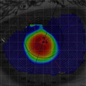 keratoconus-300x300